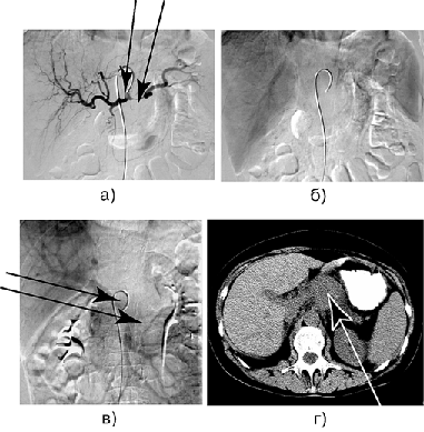 Больная Ш. Рак тела и хвоста поджелудочной железы с инвазией чревного ствола, общей печеночной артерии, селезеночной артерии, селезеночной вены и верхней брыжеечной вены