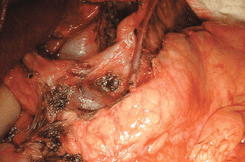 Лимфодиссекция зоны чревного ствола (выделены левая желудочная вена и левая желудочная артерия на протяжении)