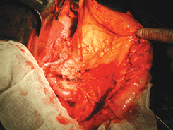 Бурсосегментэктомия