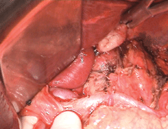 Лимфодиссекция печеночно-двенадцатиперстной связки (видны воротная вена и общая печеночная артерия)