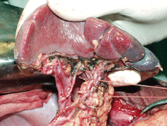 Мобилизация панкреато-лиенального комплекса с лимфодиссекцией ворот селезенки 2