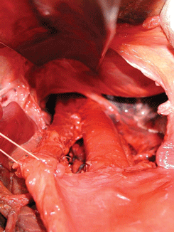 Трансхиатальная мобилизация пищевода с лимфодиссекцией заднего средостения