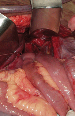 Окончательный вид раны после трансхиатальной резекции пищевода и формирования медиастинального пищеводно-кишечного анастомоза