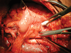 Мобилизация двенадцатиперстной кишки по Кохеру