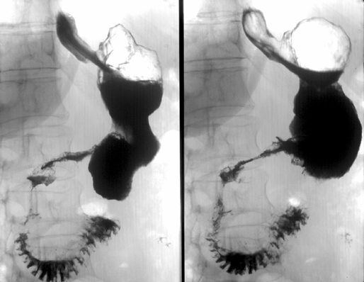 Рак антрального отдела желудка 2