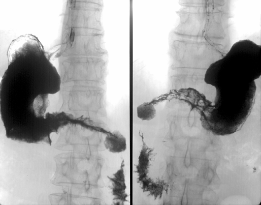 Рак антрального отдела желудка 1