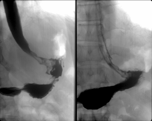 Рак проксимального отдела желудка 1