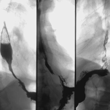 Рак проксимального отдела желудка 2