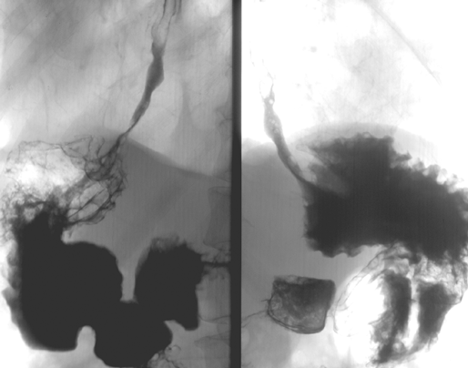 Рак проксимального отдела желудка с переходом на пищевод