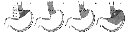 Типы рака пищеводно-желудочного перехода по классификации J.R. Siewert