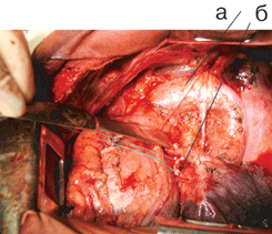 Вид послеоперационной раны после верхней лобэктомии слева с систематической медиастинальной лимфодиссекцией
