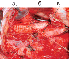 Вид послеоперационной раны после пневмонэктомии справа с систематической медиастинальной лимфодиссекцией