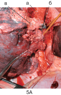 Этап 1 пневмонэктомии справа с циркулярной резекцией бифуркации трахеи