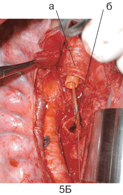 Этап 2 пневмонэктомии справа с циркулярной резекцией бифуркации трахеи