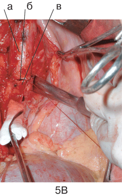 Этап 3 пневмонэктомии справа с циркулярной резекцией бифуркации трахеи