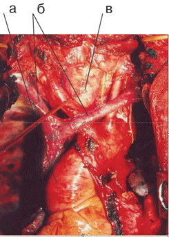 Вид послеоперационной раны после систематической медиастинальной билатеральной лимфодиссекции