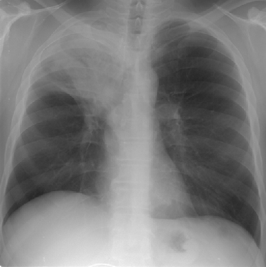 Центральный рак верхней доли правого легкого с ателектазом доли
