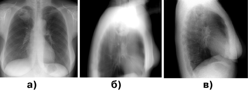Периферический рак верхней доли правого легкого, полостная форма
