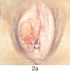 Простая вульвэктомия 1