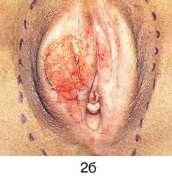 Простая вульвэктомия 2