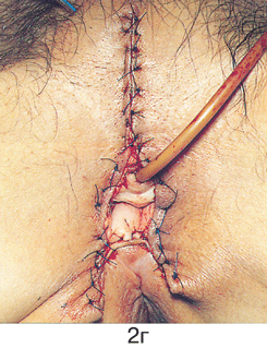 Простая вульвэктомия 4