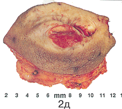 Простая вульвэктомия 5