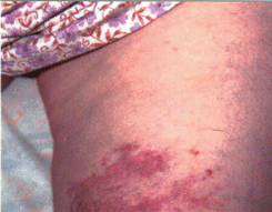 Пятнистый элемент саркомы Капоши в области бедра