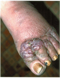 Узловой элемент саркомы Капоши в области стопы