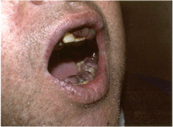 Узловые элементы саркомы Капоши на слизистой оболочке полости рта