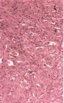 Микропрепарат. Узловой элемент саркомы Капоши