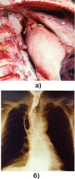 Рентгенограмма контрастированного пищеводно-желудочного анастомоза