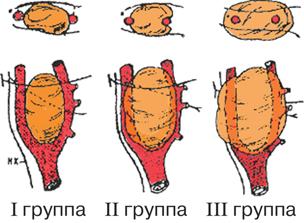 Классификация каротидных хемодектом по Shambler