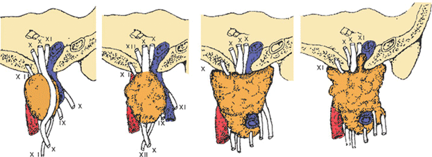 Клинические варанты параганглиом блуждающего нерва