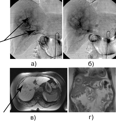 Б-ная И., 64 года. Рак прямой кишки, состояние после брюшно-промежностной экстирпации прямой кишки