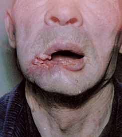 Рак нижней губы (ранняя форма). Опухолевый валик по краям эрозии свидетельствует об озлокачествлении