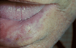 Рак нижней губы III стадии, язвенно-инфильтративная форма