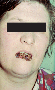 Рак нижней губы III стадии, экзофитная форма