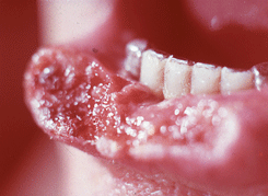 Распространенный рак нижней губы IVA стадии. Опухоль разрушает нижнюю губу, щеки, мягкие ткани подбородка, нижнюю челюсть. Имеются метастазы в поднижнечелюстных лимфатических узлах