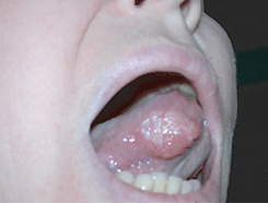 Рак боковой поверхности языка, развившийся на фоне лейкоплакии