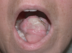 Рак языка, язвенно-инфильтративная форма