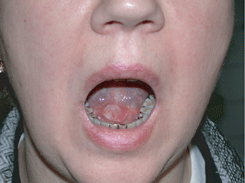 Рак дна полости рта, язвенная форма роста