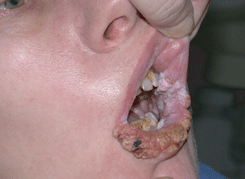 Рак слизистой оболочки щеки, развившийся по линии смыкания зубов и угла рта на фоне лейкокератоза