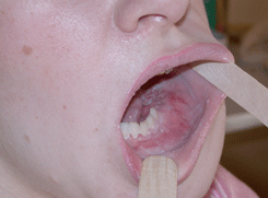  Рак слизистой оболочки альвеолярной части нижней челюсти