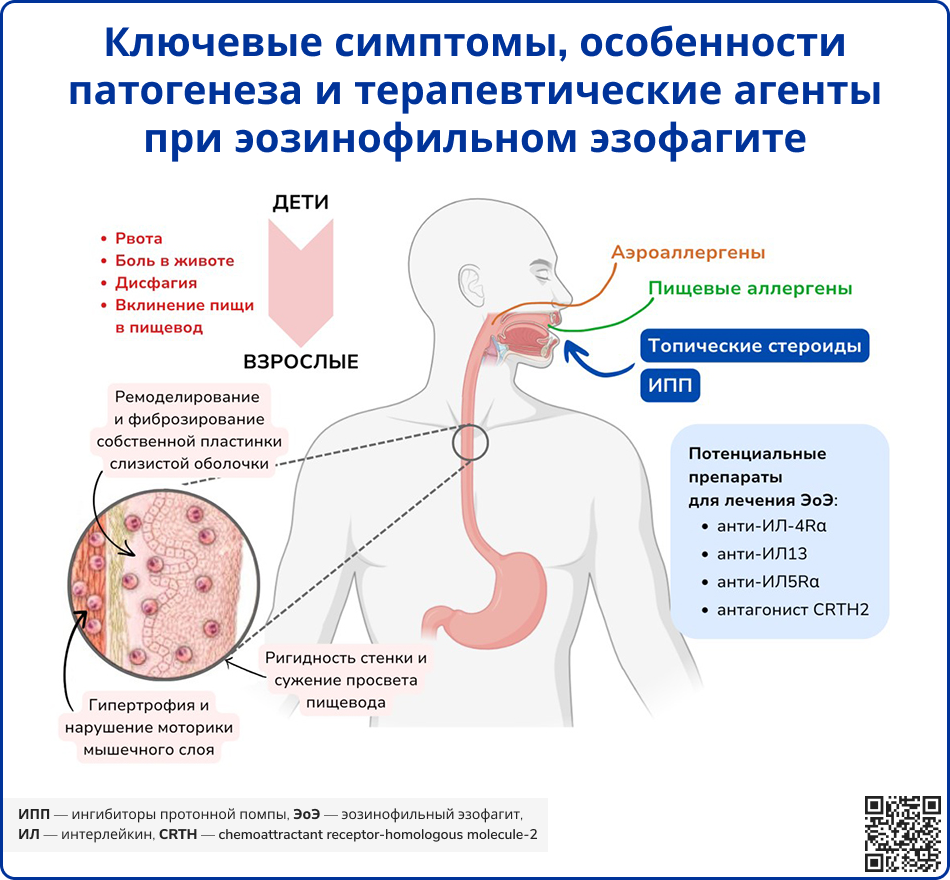 Ключевые симптомы, особенности патогенеза и терапевтические агенты при эозинофильном эзофагите