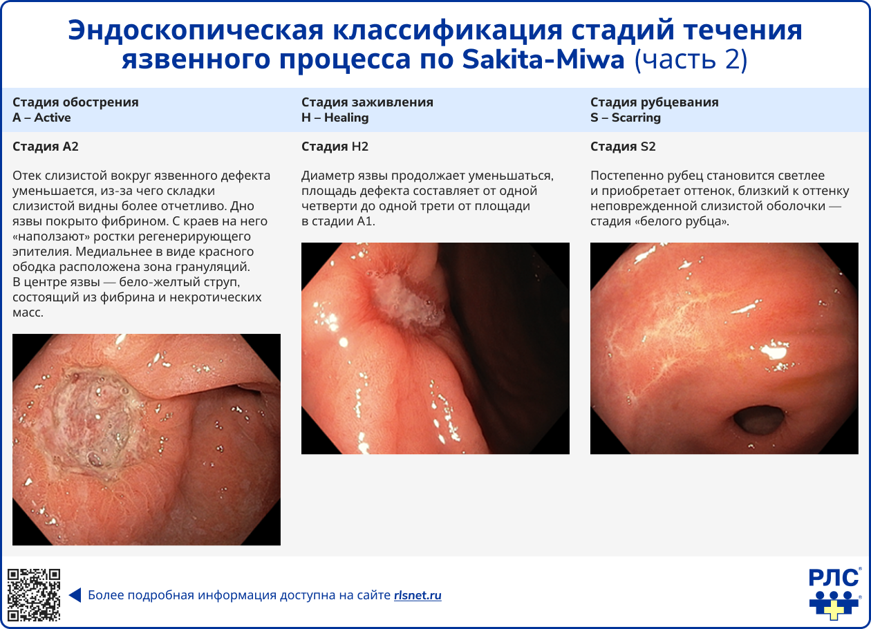 Эндоскопическая классификация стадий течения язвенного процесса по Sakita-Miwa часть 2