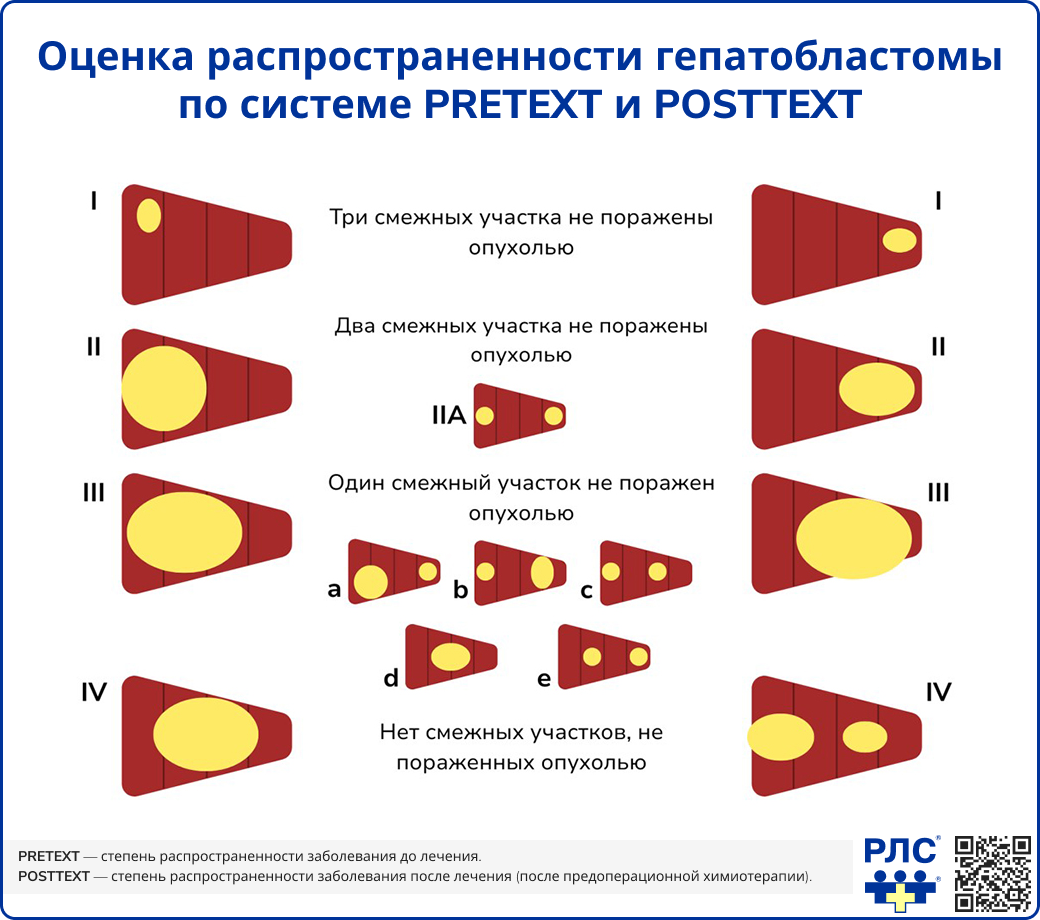Оценка распространенности гепатобластомы по системе PRETEXT и POSTTEXT