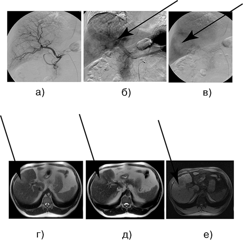 Больной М., 49 лет. Рак желчного пузыря, с инвазией печени, проксимального отдела внепеченочных желчных протоков