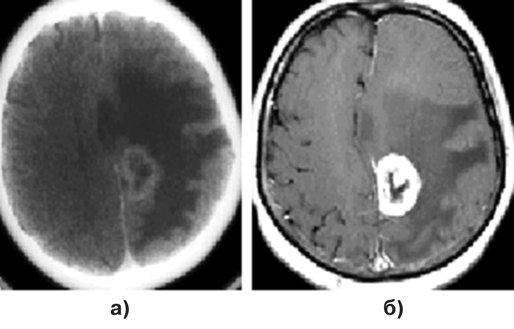 Метастаз аденокарциномы в медиальные отделы теменной доли слева