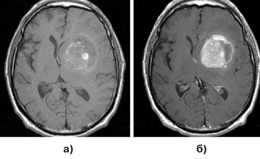 Метастаз меланомы в лобно-височную область слева