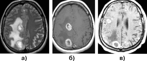 Множественные метастазы в головной мозг